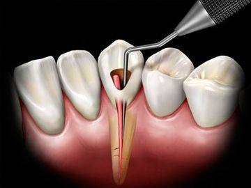 Endodoncia 